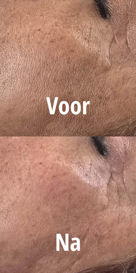 Rubeskin voor na use mobiel